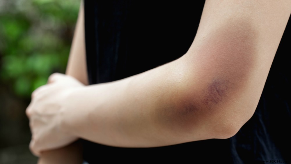 4 Proven Ways to Heal Bruises Faster