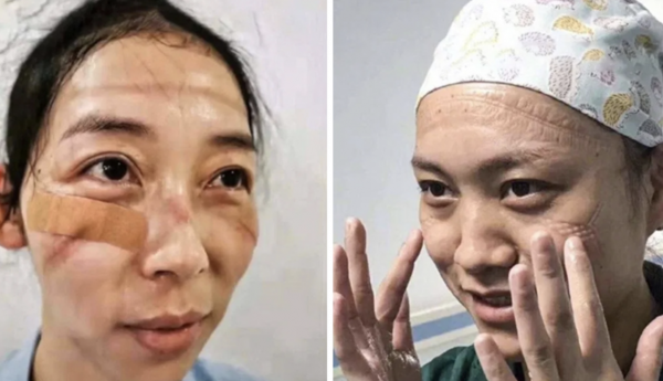 Chinese Nurses Reveal COVID-19 Battle Toll Through Marked Face Photos