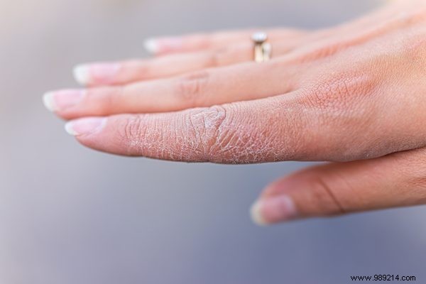 Dry Hands from Frequent Washing Affect 65% of Dutch – Yet Many Do Nothing