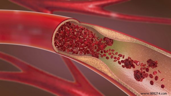 COVID-19 s Hidden Risk: Life-Threatening Blood Clots in Critically Ill Patients