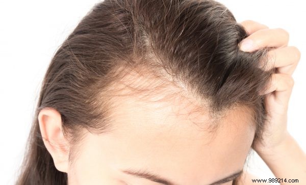 Hair Loss: A Taboo Affecting Over Half of Dutch Adults