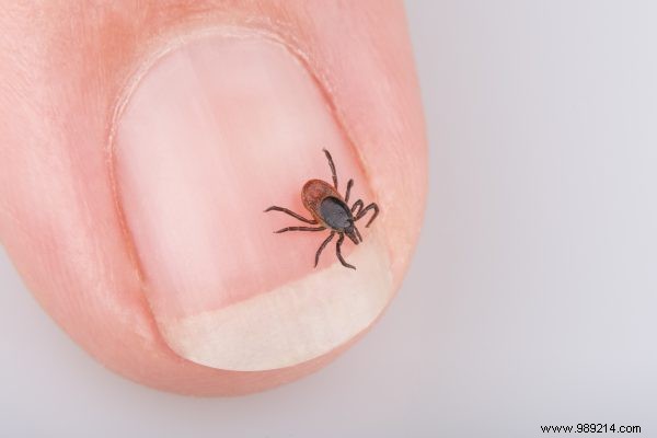 Tick Bite Essentials: Safe Removal, Warning Signs, and Prevention Tips