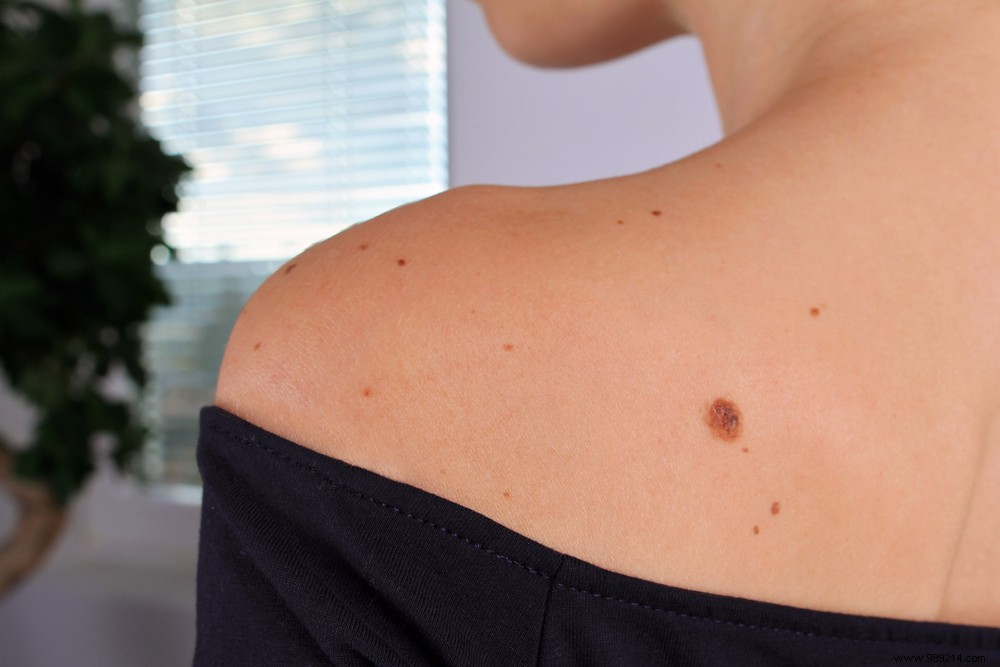 5 Expert Tips to Monitor Your Moles for Early Skin Cancer Detection