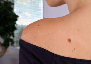 5 Expert Tips to Monitor Your Moles for Early Skin Cancer Detection