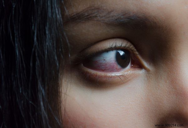 How to Treat and Prevent an Inflamed Eyelid (Stye): 4 Expert Tips