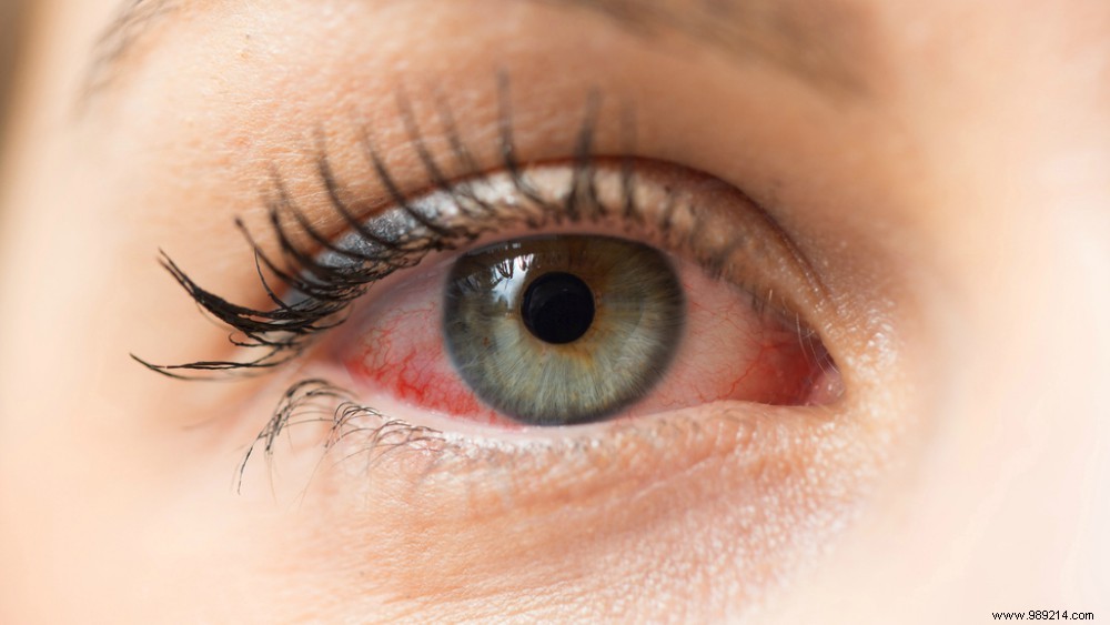 7 Common Causes of Red Eyes and How to Find Relief