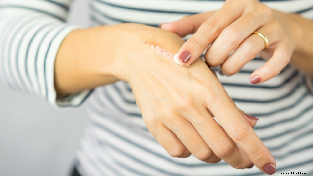 Expert Tips: How to Help Wounds Heal Beautifully and Minimize Scarring