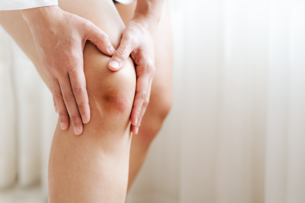 9 Common Reasons You Bruise Easily – And When to See a Doctor