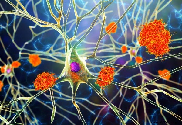 Maastricht University Breakthrough: Brainstem Marker Signals Alzheimer s Risk Decades Early