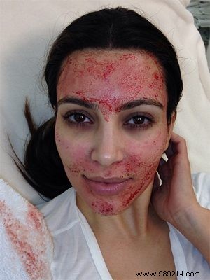 Vampire Facial Explained: Kim Kardashian s Controversial Blood Rejuvenation Treatment