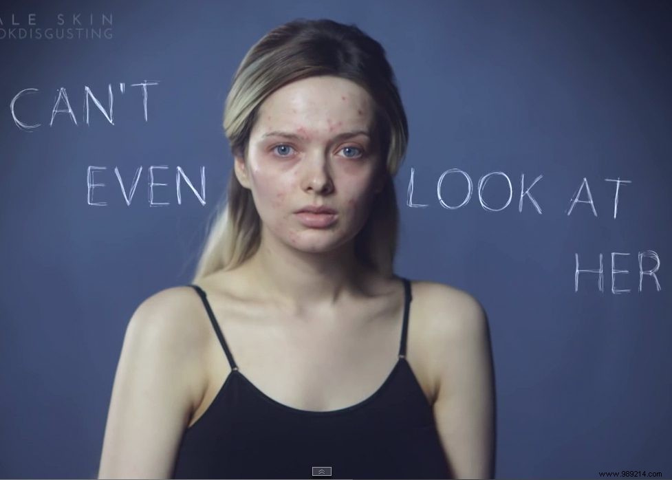 Em Ford s Viral Video: Empowering Response to Acne Comments