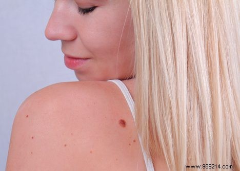 65% of Dutch Adults Aged 20-50 Skip Regular Skin Checks for Suspicious Spots, Research Shows