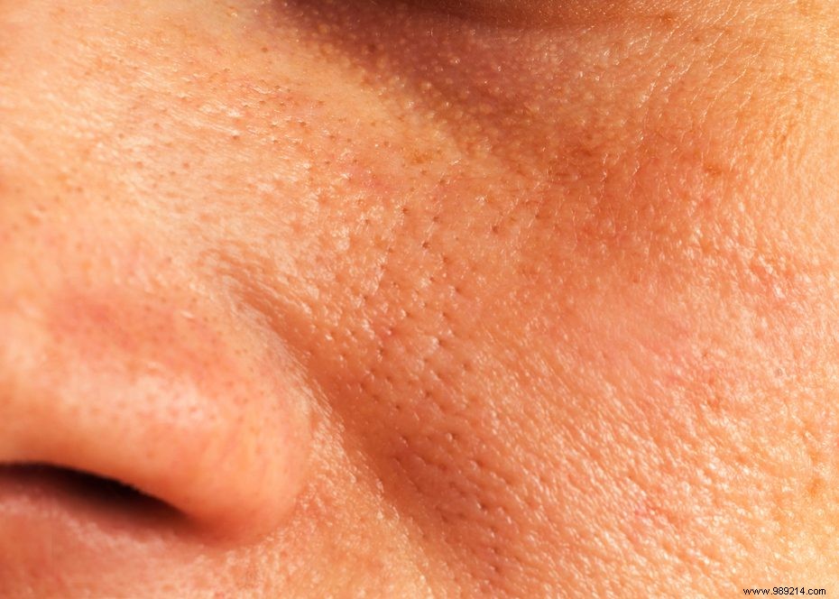 What Are Coarse Pores? Causes, Expert Insights & Camouflage Tips