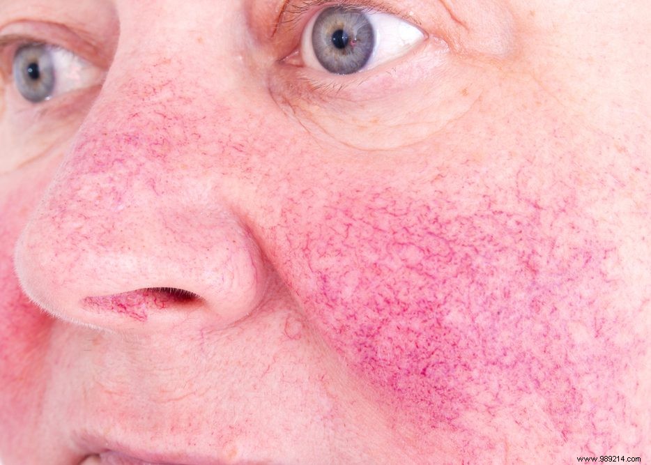 What Is Couperose? Causes, Symptoms, and Effective Management