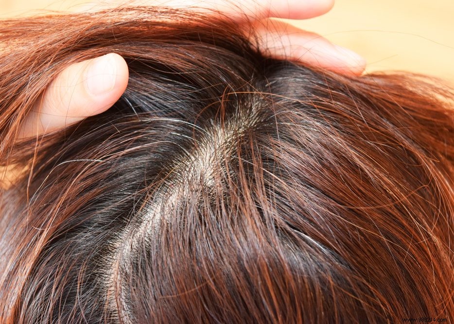 Premature Gray Hair: Signs, Causes, and Genetic Factors Explained