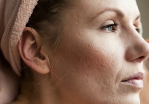 Expert Guide: Managing Rosacea with Proven Skincare and Lifestyle Tips
