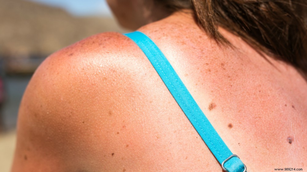 Sunburned? Expert Tips to Soothe and Heal Your Skin Fast