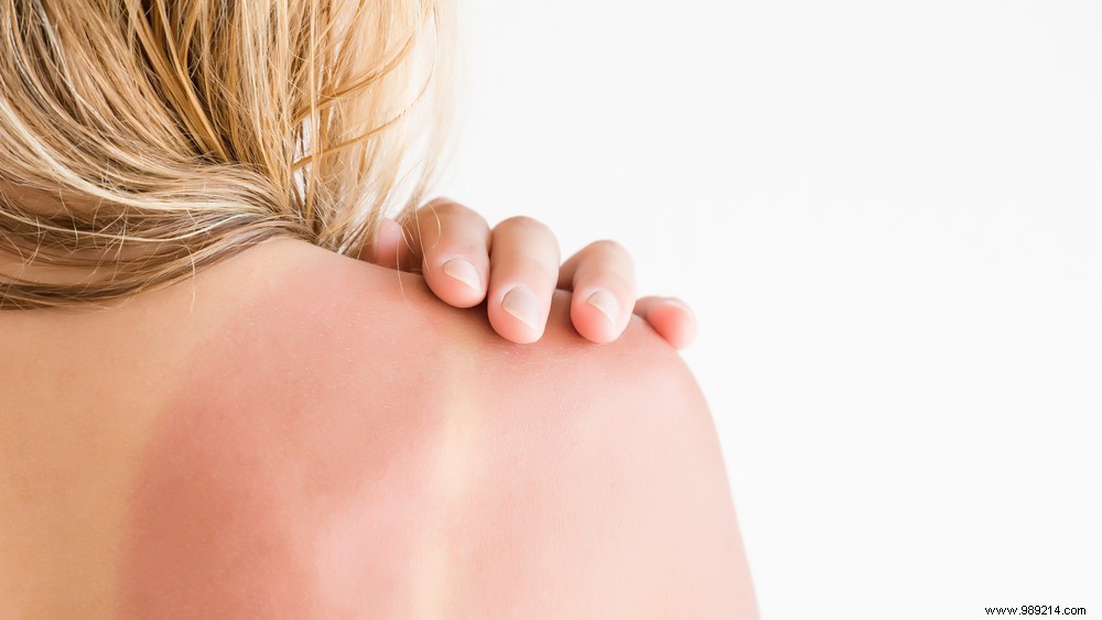 Why Does Your Skin Peel After a Sunburn? The Science and Prevention Tips