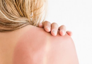 Why Does Your Skin Peel After a Sunburn? The Science and Prevention Tips