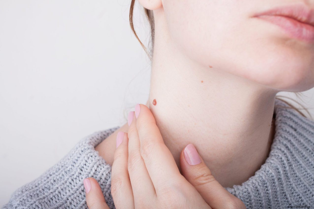 What Is a Mole? Understanding Birthmarks and Common Skin Spots