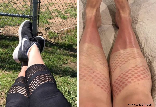 Shocking Sunburn Photos: Real Consequences of Skipping Sunscreen