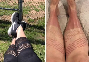 Shocking Sunburn Photos: Real Consequences of Skipping Sunscreen