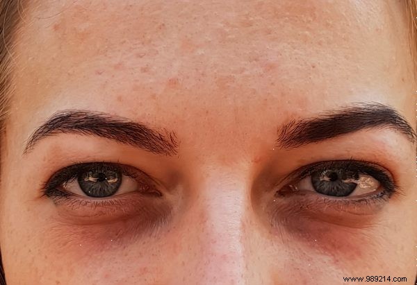 Myth Busted: Are Dark Circles Under Your Eyes Really Your Fault?