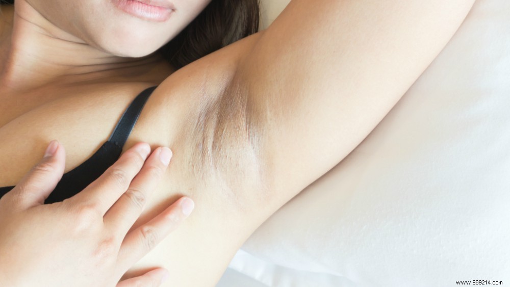 How to Prevent and Safely Treat Ingrown Hairs for Smoother Skin