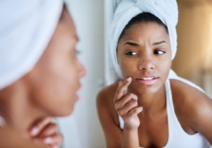 How to Get Rid of Pimples Fast: Expert Skincare Advice for Clear Skin