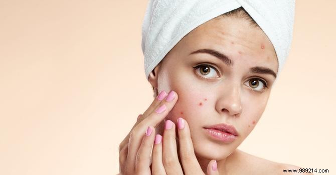 8 Expert Habits to Effectively Combat Acne Breakouts