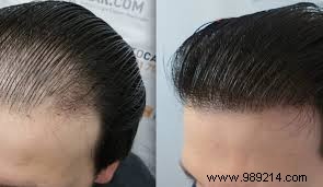 Why Hair Transplant Stands Out as the Top Choice for Treating Baldness
