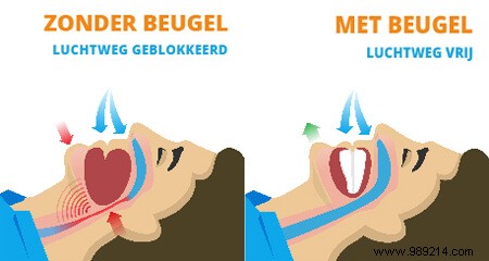 Why ENT Doctors Recommend Anti-Snoring Mouthpieces: Science-Backed Relief for Better Sleep