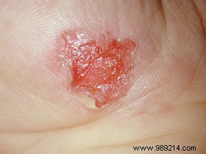 Essential First Aid for Household Accidents: Expert Steps to Stay Safe