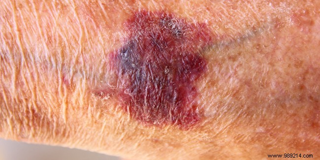 Why Hematomas Are Common in Older Adults: Expert Insights on Causes