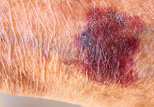 Why Hematomas Are Common in Older Adults: Expert Insights on Causes