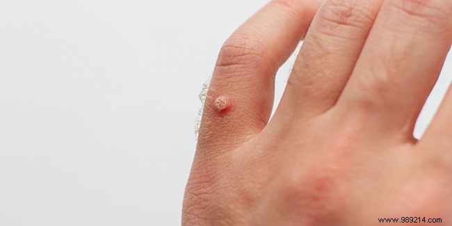 Proven Solutions for Permanently Removing Warts: Dermatologist-Recommended Treatments