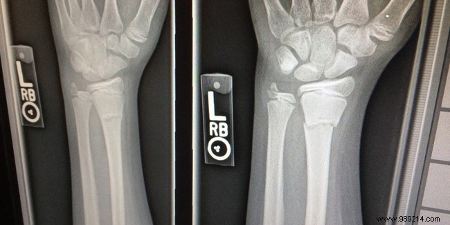 Osteoporosis in Seniors: Causes, Symptoms, Diagnosis, and Treatment