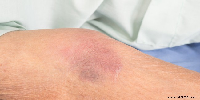 Subdural Hematoma in the Elderly: Causes, Symptoms, and Treatment