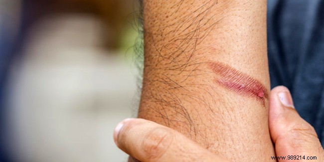 The Gift of Fire Cutting: A Grandparent s Timeless Remedy for Burns?