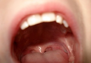 Natural Remedies for Canker Sores: Proven Home Treatments for Fast Relief