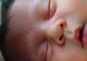 Top 3 Common Skin Conditions in Babies: Causes, Symptoms, and Safe Treatments