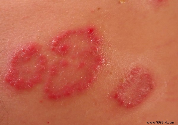 Top 3 Common Skin Conditions in Babies: Causes, Symptoms, and Safe Treatments