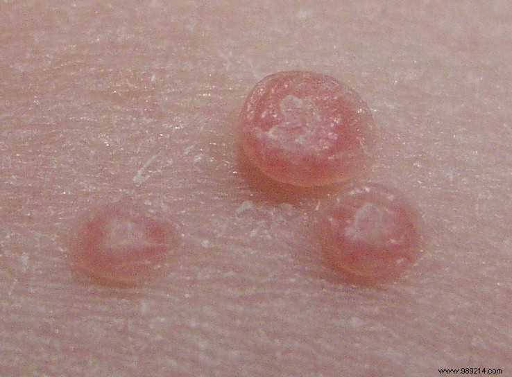 Molluscum Contagiosum: How to Recognize and Treat This Common Skin Infection