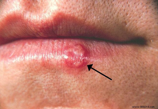 Cold Sores Explained: Symptoms, Causes, Effective Treatments, and Prevention