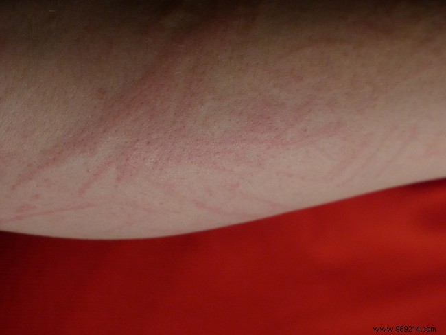 Skin Allergies Explained: Common Allergens, Prevention Strategies, and Proven Treatments