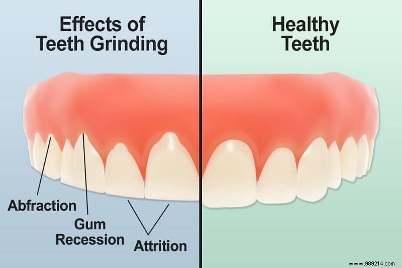 Bruxism: Causes, Risks, and Effective Treatments for Teeth Grinding