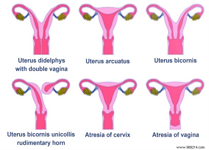 19-Year-Old Diagnosed with Rare Uterus Didelphys After Years of Severe Pain and Misdiagnosis