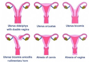 19-Year-Old Diagnosed with Rare Uterus Didelphys After Years of Severe Pain and Misdiagnosis