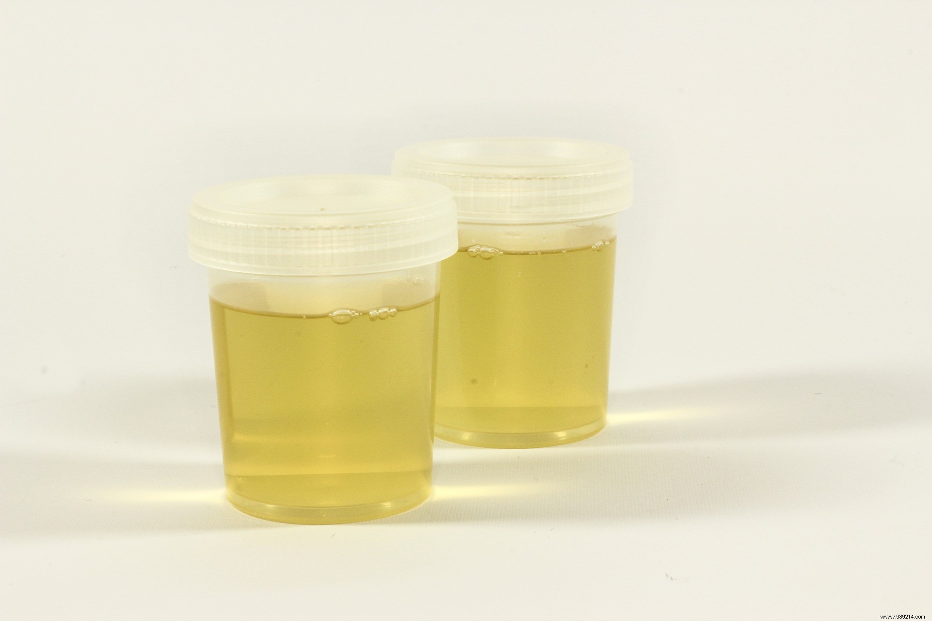 New At-Home Urine Test Detects Prostate Cancer and Aggressiveness – A Comfortable Alternative to Rectal Exams