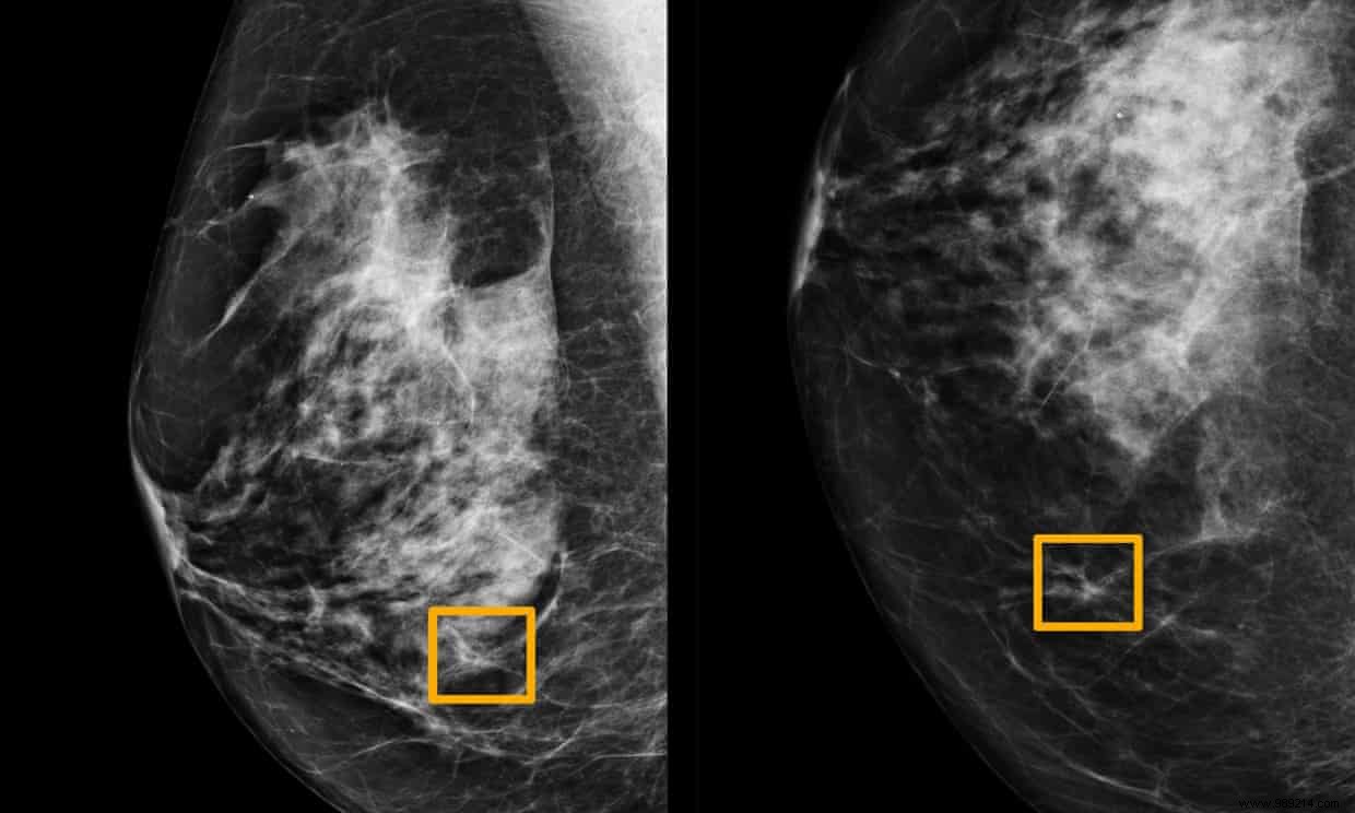 Study Reveals AI Outperforms Radiologists in Breast Cancer Detection from Mammograms